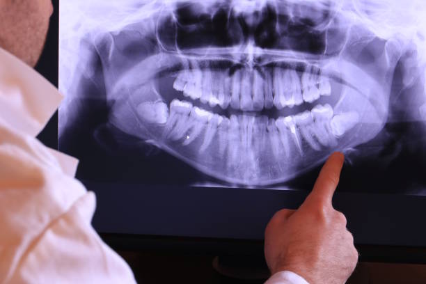 Best Emergency Wisdom Tooth Extraction in Metuchen, NJ